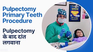 Pulpectomy Primary Teeth Procedure  Pulpectomy के बाद दांत लगवाना [upl. by Ahsielat]