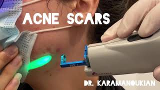 Acne Scar Update Using VBeam Laser in Los Angeles Reduce Redness and Thickness of Facial Scars [upl. by Lytsyrk162]