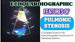 Echocardiographic Assessment Of Pulmonic Stenosis [upl. by Donall]