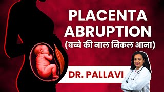 Placenta Abruption Causes Symptoms Diagnosis amp Treatment  Explained in Hindi  Abruptio Placentae [upl. by Nahseez]