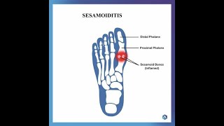 Sesamoiditis Inflammation of Sesamoid Bones  Causes Symptoms Diagnosis Treatment [upl. by Lavena]