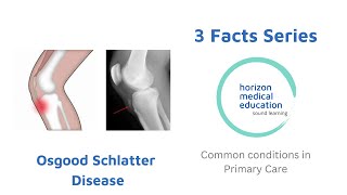 Osgood schlatter disease  Knee pain in young people  bony bump below the knee [upl. by Lowndes339]