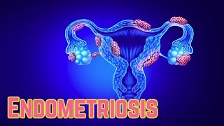 Endometriosis Update 2018  CRASH Medical Review Series [upl. by Adena581]