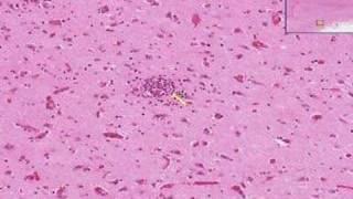 Histopathology Brain Viral encephalitis [upl. by Aneehsor]