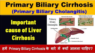 Primary Biliary Cirrhosis  Primary Biliary Cholangitis [upl. by Pricilla]