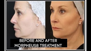 BEFORE AND AFTER MY MORPHEUS 8 TREATMENT [upl. by Tirma]