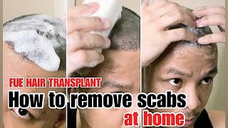 How to remove scabs after hair transplant  cleaning your scalp at home  FUE IN THE PHILIPPINES [upl. by Janene]