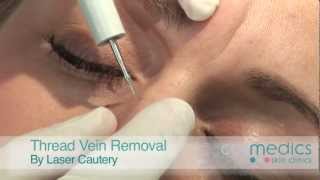 Thread Vein Removal on Face by Laser  London [upl. by Tris]