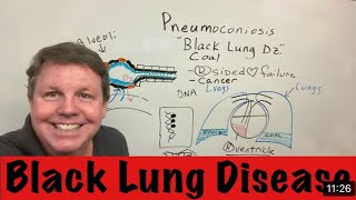 Pneumoconiosis Black Lung Disease [upl. by Malsi]