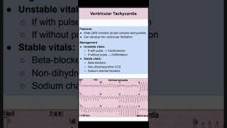 Ventricular Tachycardia [upl. by Auhoj697]