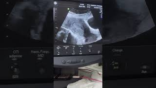 Two different cases of Endometrial Hyperplasia diagnostic ultrasound cases [upl. by Ahsineg]