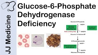 Glucose6Phosphate Dehydrogenase Deficiency  Symptoms Pathophysiology Diagnosis and Treatment [upl. by Ahsinehs]