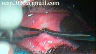 Conjunctival Graft Suturing For Pterygium Excision With Autograft By Dr Sudhir Singh 33 [upl. by Dory809]