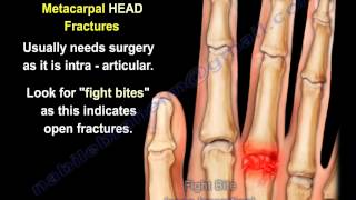 Metacarpal Fractures  Everything You Need To Know  Dr Nabil Ebraheim [upl. by Adaline]