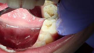 Back Tooth filling procedure [upl. by Necila]