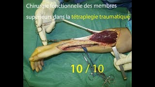 Membres supérieurs tétraplégiques 1010  indications [upl. by Eetsud]