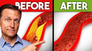 Best Nutrients to Remove Plaque from Arteries [upl. by Namaj]