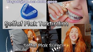 Şeffaf Plak Taktırdım  invisalign Tedavisi  Şeffaf Plak Sürecinde Yaşadıklarım [upl. by Rubel]