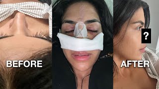 I Got A Revision Rhinoplasty Surgery [upl. by Johna]