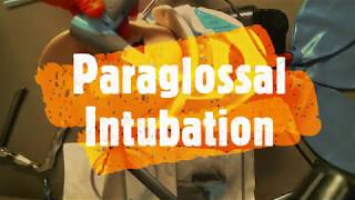 Vie Scope® Paraglossal Intubation OffMolar Intubation [upl. by Hetti]