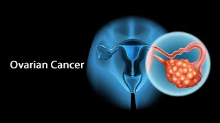 What Is Ovarian Cancer [upl. by Chapell595]