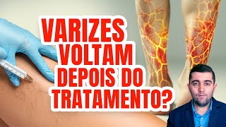 Varizes Diga Adeus com o Tratamento Certo Laser Cirurgia Aplicação ou Espuma Densa Qual melhor [upl. by Lamson]