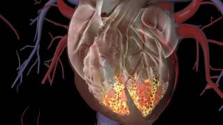 Asian Heart Hospital  How Heart Pacemaker surgery is performed [upl. by Lorrad]