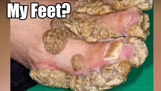 Thickest Feet Skin Palmoplantar Keratoderma PPK [upl. by Debbra]