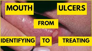 Mastering Recurrent Aphthous Stomatitis Most Common Mouth Ulcers and Effective Treatment Strategies [upl. by Yseulte837]