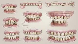 Getting a Dental Bridge What to Expect Before During and After  How Does the Procedure Work [upl. by Niotna937]