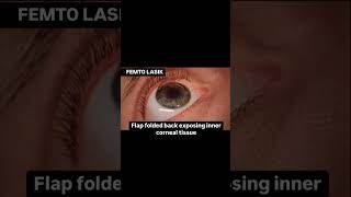 Femto Lasik eyes ophthalmology optometry [upl. by Esaele]