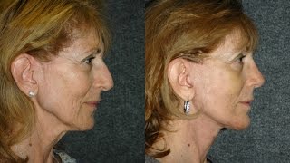 Mini Face Lift Necklift and Rhinoplasty 3 Weeks After Surgery  minifacelift [upl. by Albie]