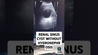 RENAL SINUS CYST WITHOUT HYDRONEPHROSIS usg radiology kidneyanatomy [upl. by Lirrehs]