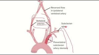 Subclavian steal syndrome MRCS question solve CRACK MRCS [upl. by Aneleasor379]