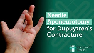 Needle Aponeurotomy for Dupuytrens Contracture [upl. by Foulk]