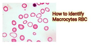 Macrocytes RBC [upl. by Nnayrrehs]