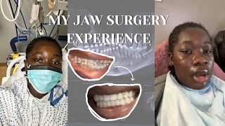 WHY I GOT JAW SURGERY AT 22  CORRECTIVE JAW SURGERY [upl. by Stevena]