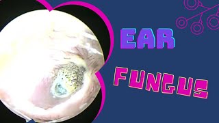 FUNGAL INFECTION EAR OTOMYCOSIS [upl. by Saddler297]