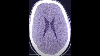 Acute Brain edema post cardiac arrest [upl. by Aisital]