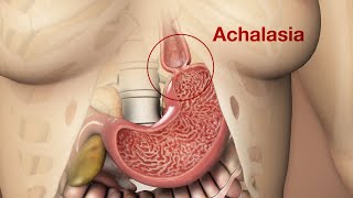 Symptoms of Achalasia amp Clinical Presentation [upl. by Katti]