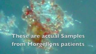 MORGELLONS Real or Delusion Under the Microscope [upl. by Assirac]