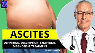 ASCITES Definition Description Causes and symptoms Diagnosis amp Treatment of Ascites [upl. by Eitsyrk]