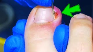 Instant Relief in 1 Minutes with This Pedicurists Ingrown Toenail Removal Technique [upl. by Aianat]