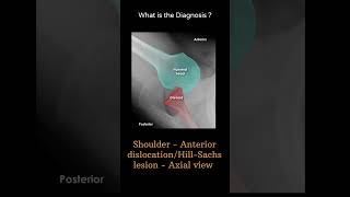 ShoulderAnterior dislocationHillSachs lesion Axial view 108 Upper limb G1 radiologychannel007 [upl. by Yasdnil]