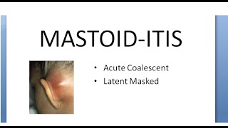 ENT Mastoiditis What is Mastoid Inflammation Infection Acute Coalescent Pain behind ear [upl. by Treiber243]