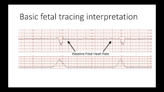 Interpreting Intrapartal fetal heart rate tracings [upl. by Ardna295]