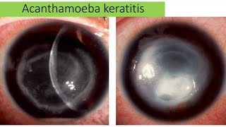 Acanthamoeba keratitis  causes sign clinical pictures management [upl. by Rebmak]