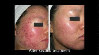 Advanced Treatments for Acne and Acne Scarring [upl. by Eugatnom]