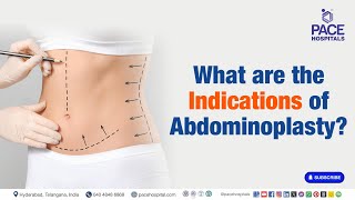 Abdominoplasty Indications  What are the Indications of Abdominoplasty  Abdominoplasty [upl. by Narut351]