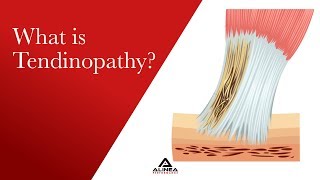 What is Tendinopathy [upl. by Ecniv]